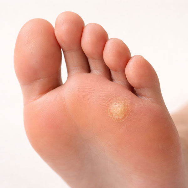 стрижневий мозоль на стопі