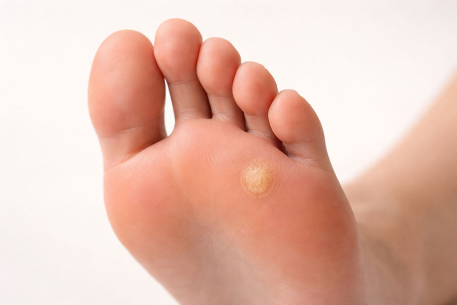 мозолі та натоптиші на стопі огрубіла шкіра на нозі