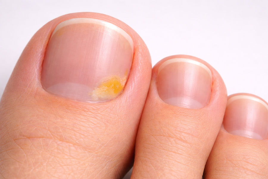 Начальная стадия грибка ногтя на большом пальце ноги – небольшое желтое пятно на краю ногтевой пластины.