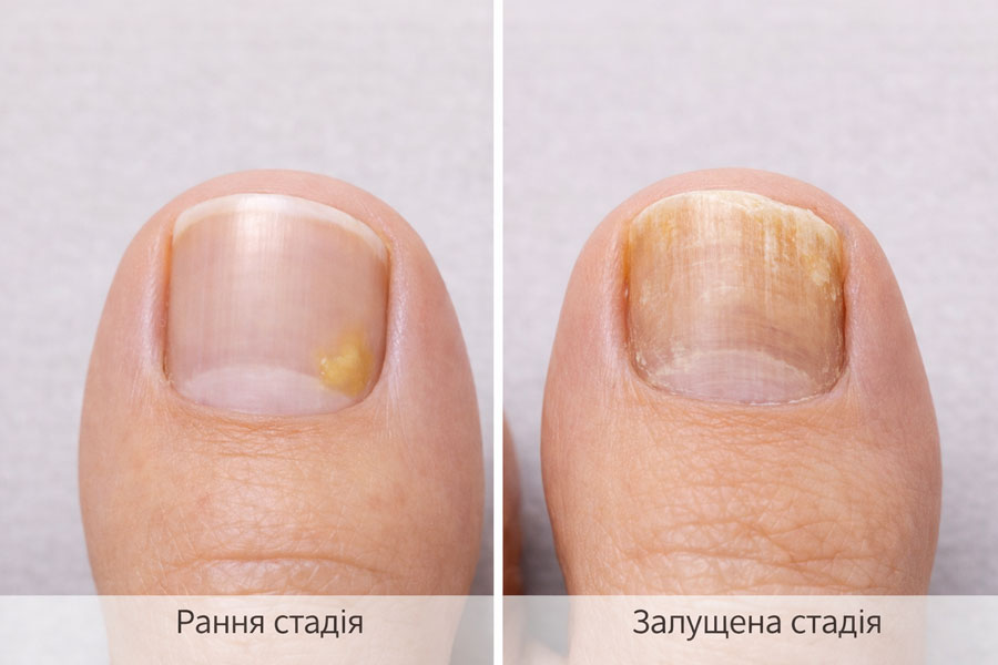 Сравнение ранней и запущенной стадии грибка ногтя на большом пальце стопы