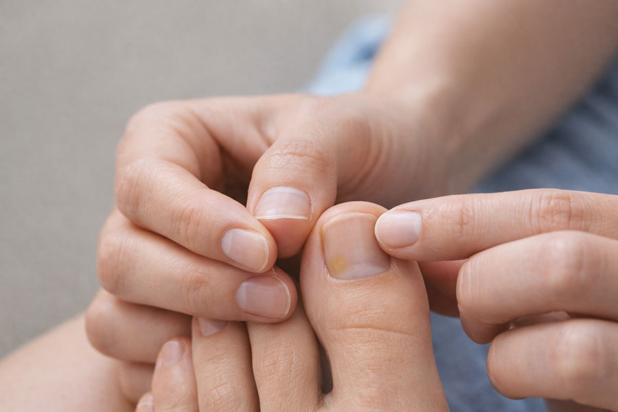 первые признаки грибка ногтей человек замечает желтое пятно на ногте