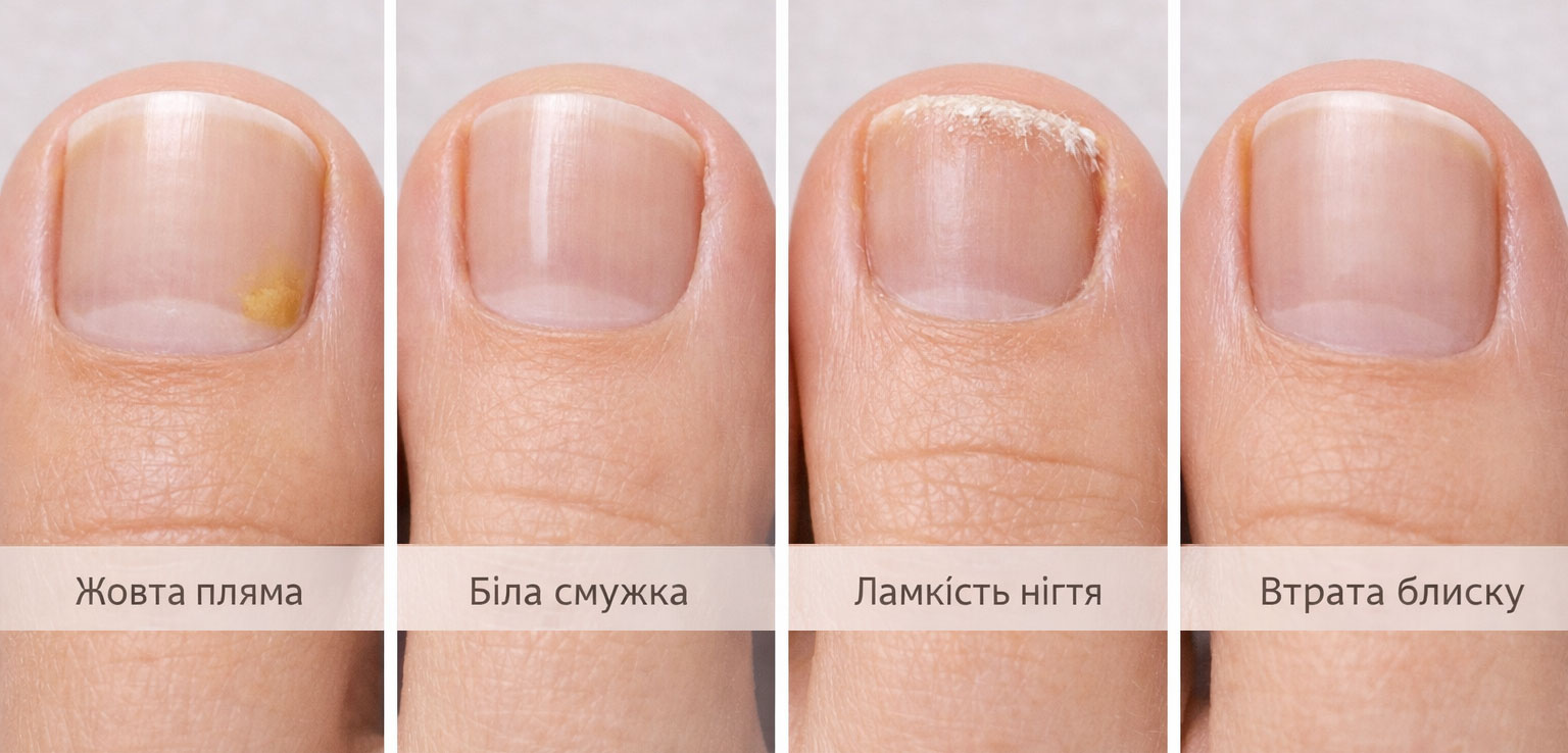 ранние симптомы грибка ногтей онихомикоз желтое пятно белая полоска ломкость ногтя