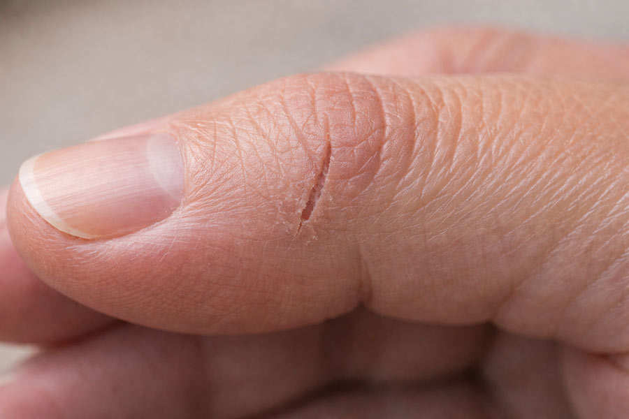 Сухая кожа рук у ногтя – зона, где часто появляются трещины на пальцах