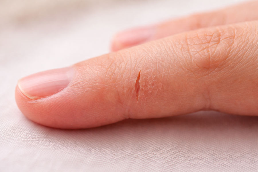 Трещины на пальцах руки крупным планом